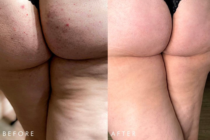 Can a Moisturizer *Really* Combat Cellulite?