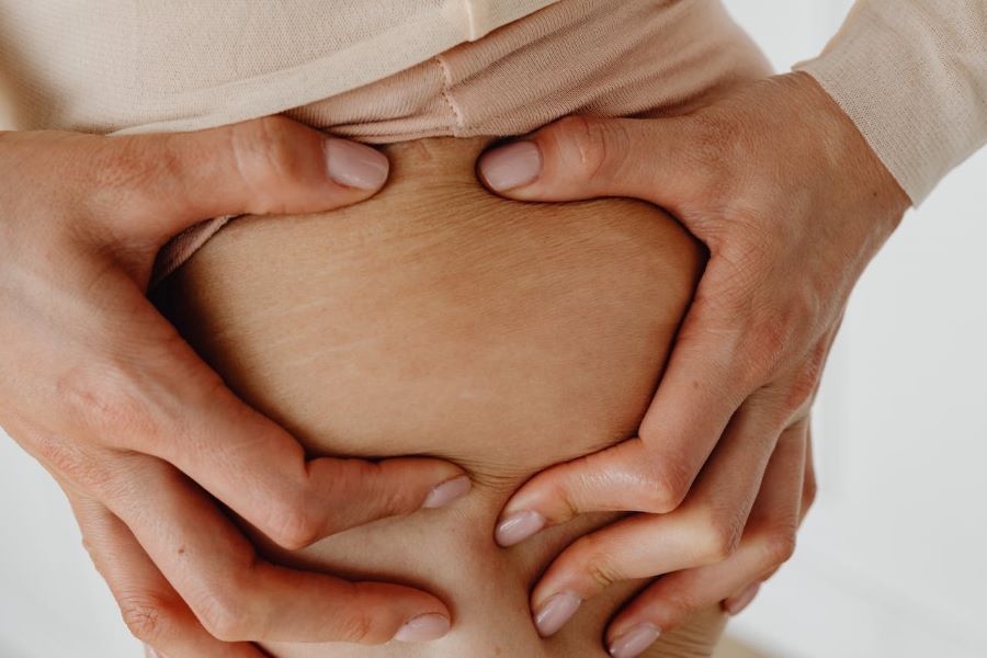 Do Stretch Marks Itch? Here's What to Do