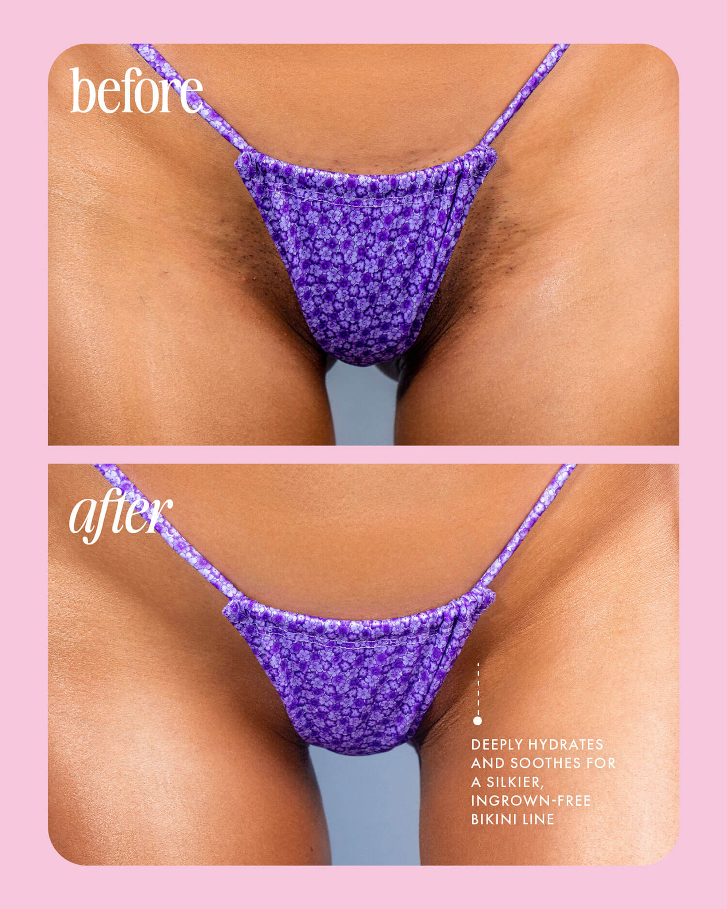 Two close-up photos of a bikini line in purple floral underwear show the “before” with visible pubic hair and texture, and the “after” with smoother, hydrated skin and fewer ingrown hairs after using Truly Beautys Cooka Oil. Text highlights its benefits.