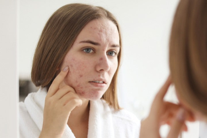 5 Derm-Approved Ways to Treat Rosacea
