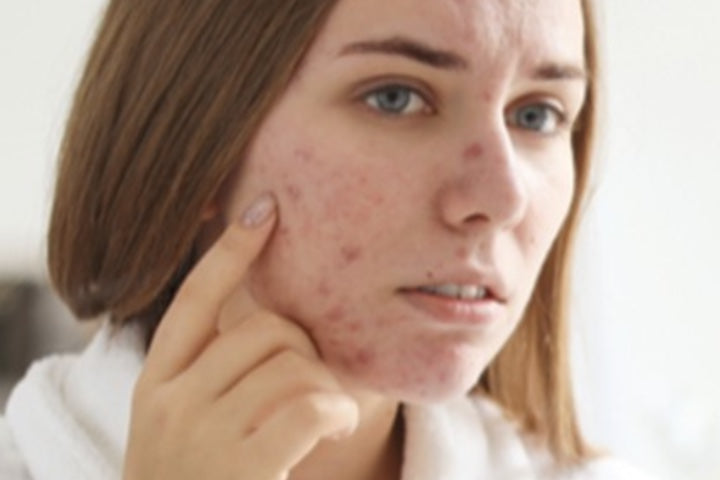 Acne Mapping: How to Read Acne