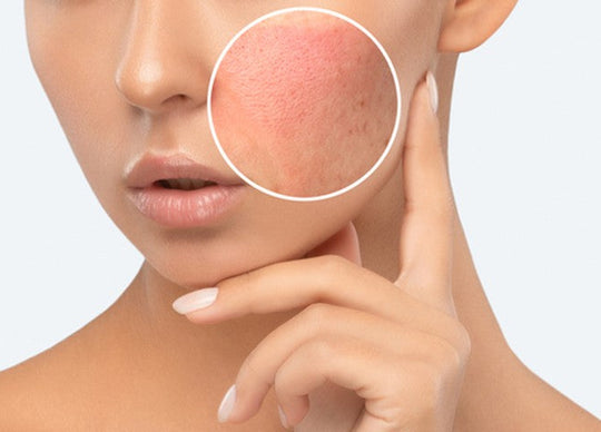 Face Mites are Real. Here's A Skincare Routine to Get Rid of Them.