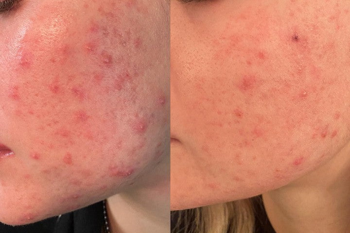 side by side images of skin purging
