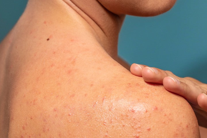 What Do Clogged Pores Look Like?