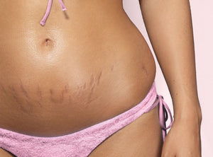 Are Stretch Marks Genetic?