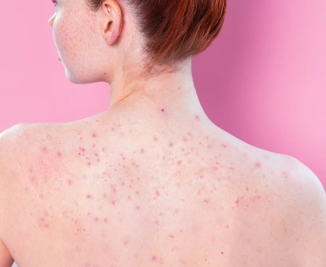 Body acne scars | A person's back with visible red pustules and scars