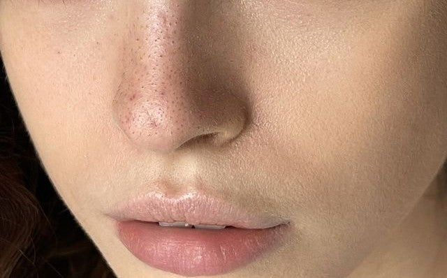 closeup of person with clogged pores on nose