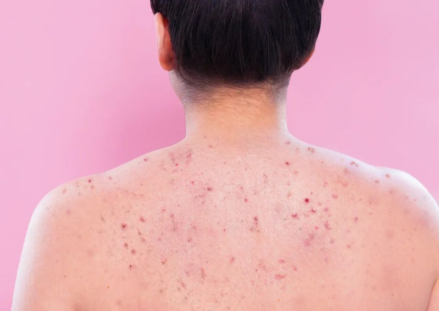 Closeup of inflamed acne across person's back | body acne photo