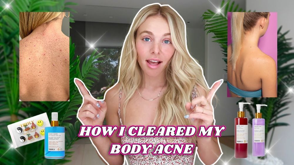 How to Get Rid of Body Acne in 5 Steps