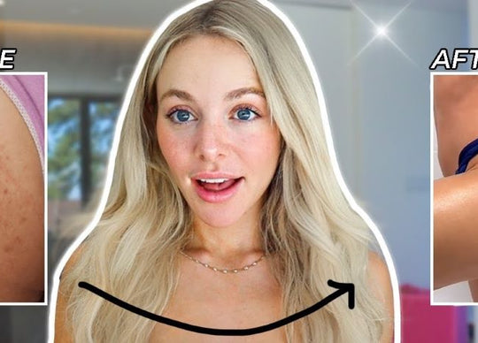 Cómo deshacerse del acné en los glúteos RÁPIDO