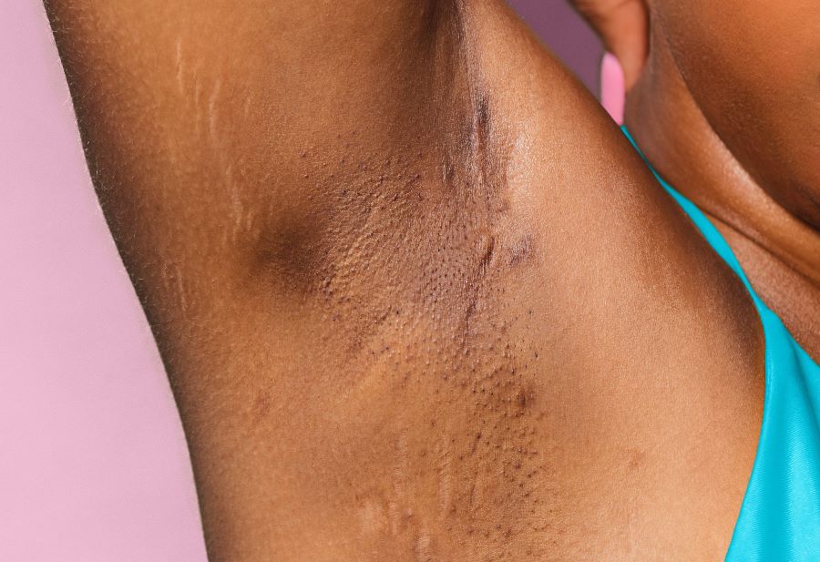 how to get rid of dark underarms | Closeup of woman's underarm with discoloration