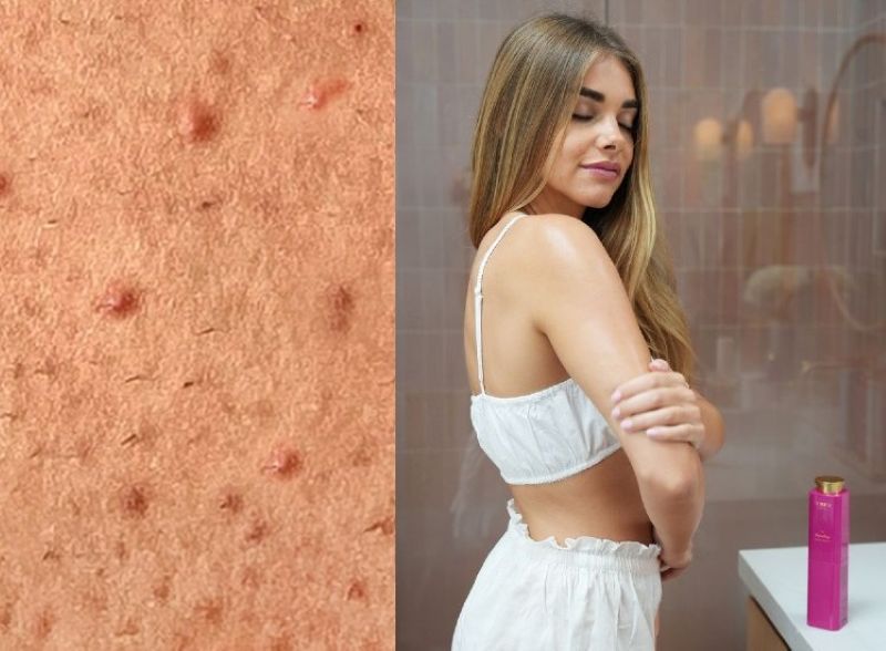 how to get rid of keratosis pilaris | side by side image displaying closeup of keratosis pilaris bumps and woman applying Truly's the smoothing body serum to arm