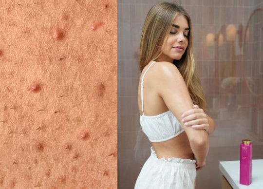 How to Clear Keratosis Pilaris