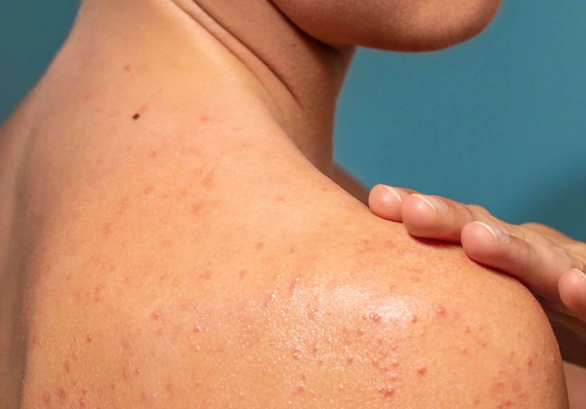 Shoulder acne | Closeup of person's upper back and shoulders with acne breakouts 