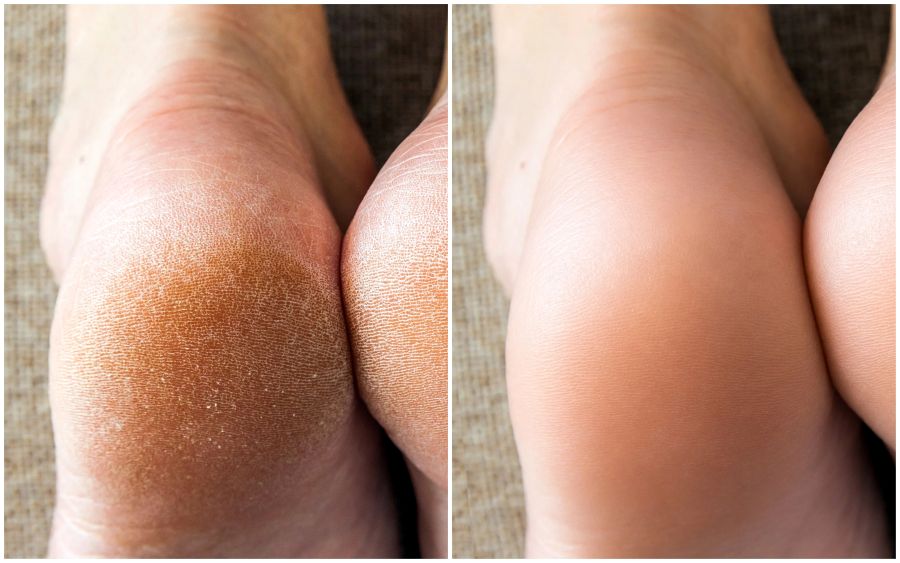 before and after photos showing foot callus on the left and visibly smoother heel on right