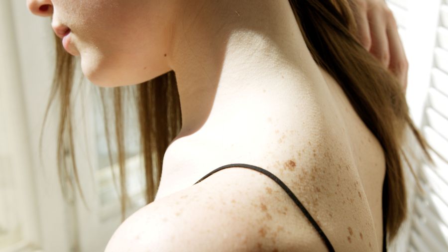 Close-up image of a woman with melasma on shoulder lit by sunlight