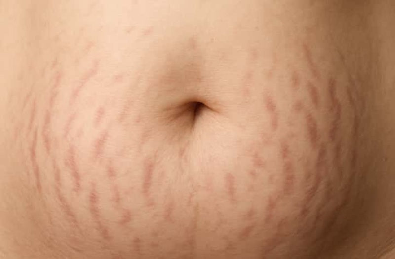 visible red stretch marks on person's belly | red vs white stretch marks