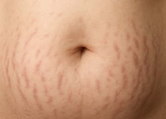 How to Prevent Stretch Marks From Working Out | group of young women working out with weights in large room