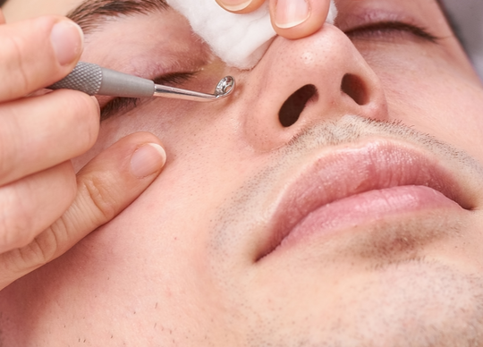 Métodos naturales para eliminar puntos negros que realmente funcionan