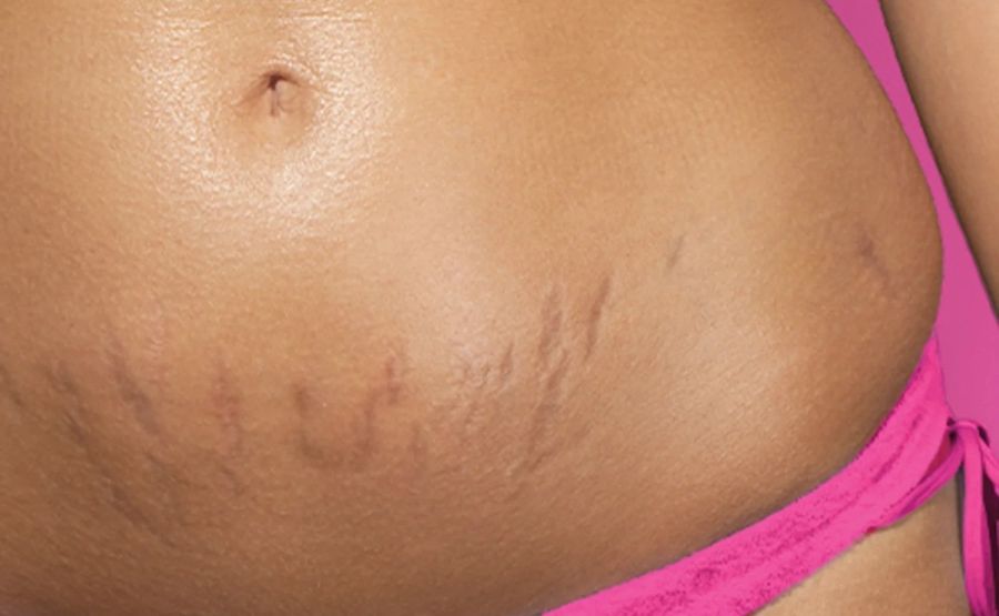 Close-up photograph showcasing stretch marks on a person's lower abdomen and hip, set against a bright pink background.