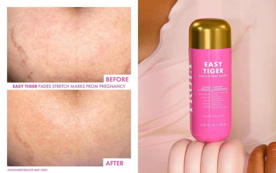 Before and after photos of stretch marks on stomach alongside a bottle of Truly's Easy Tiger Stretch Mark Eraser