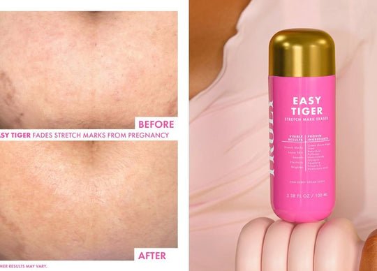 Stretch Marks on Stomach: What Actually Works?