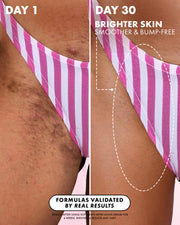 Split image shows a close-up of a person’s upper thigh in a pink and white striped swimsuit. Left side (Day 1) displays bumps and dark spots; right side (Day 30) reveals noticeably smoother, brighter skin after using the After Shave Oils Collection by Truly Beauty. Text highlights visible skin transformation. Limited-Time Offer: Buy One Get One Free!.