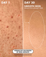 Split image: left side shows red, bumpy skin from Keratosis Pilaris labeled “Day 1”; right side shows smoother skin after 30 days using Truly Beauty's Smooth Legend After Shave Serum. Text: “Smoother, brighter, bump-free results—proven by real users.”.
