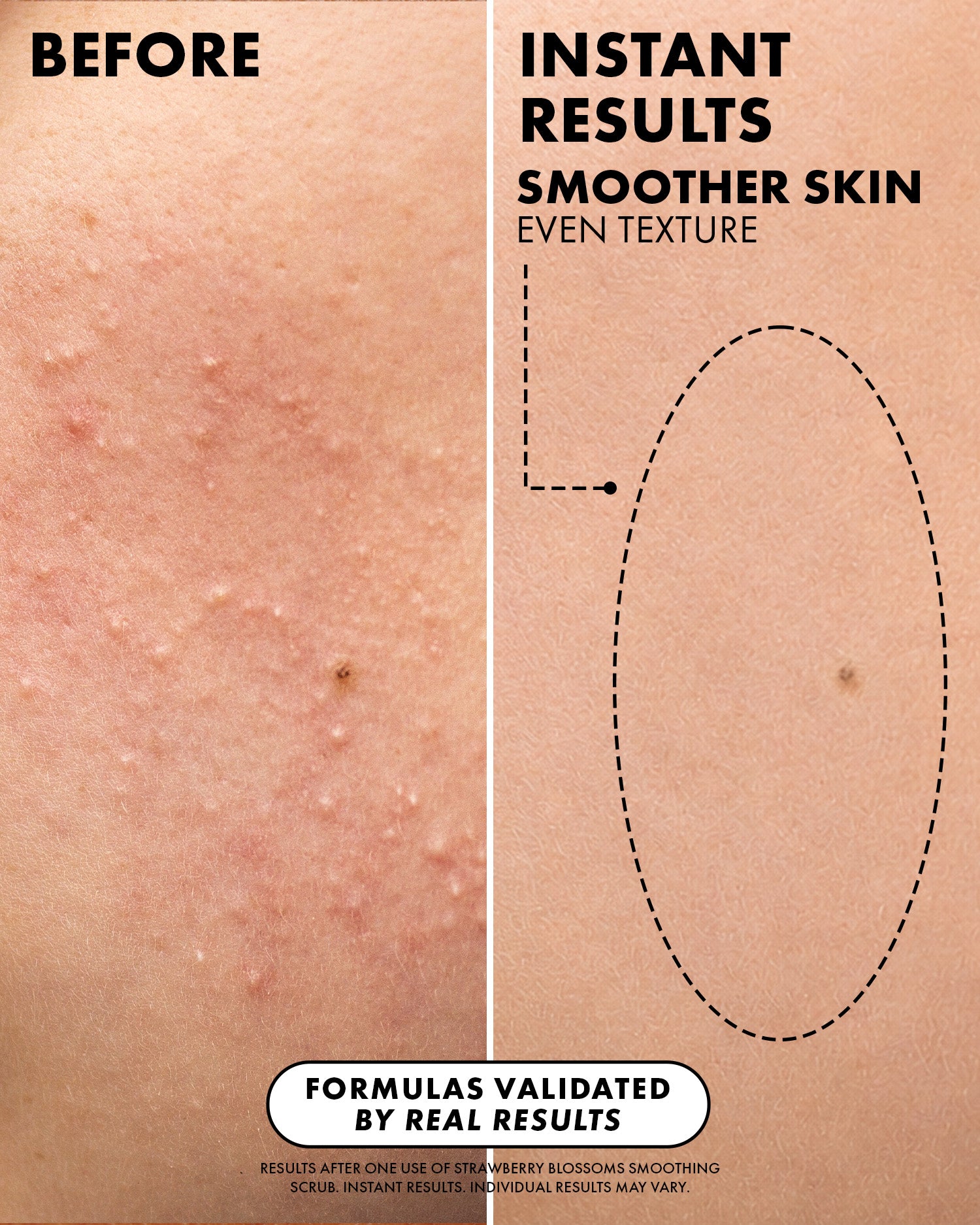 Before-and-after skin comparison showing textured acne-prone skin on the left and smoother, clearer skin on the right with text reading 'BEFORE', 'INSTANT RESULTS SMOOTHER SKIN EVEN TEXTURE', and 'FORMULAS VALIDATED BY REAL RESULTS'.