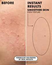 Before-and-after skin comparison showing textured acne-prone skin on the left and smoother, clearer skin on the right with text reading 'BEFORE', 'INSTANT RESULTS SMOOTHER SKIN EVEN TEXTURE', and 'FORMULAS VALIDATED BY REAL RESULTS'.