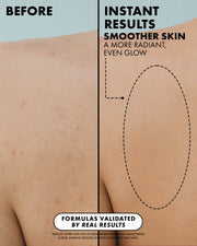 Before-and-after comparison graphic showing a close-up of a person's upper back and shoulder area, with text claiming instant smoother skin and a dashed oval highlighting the treated area.