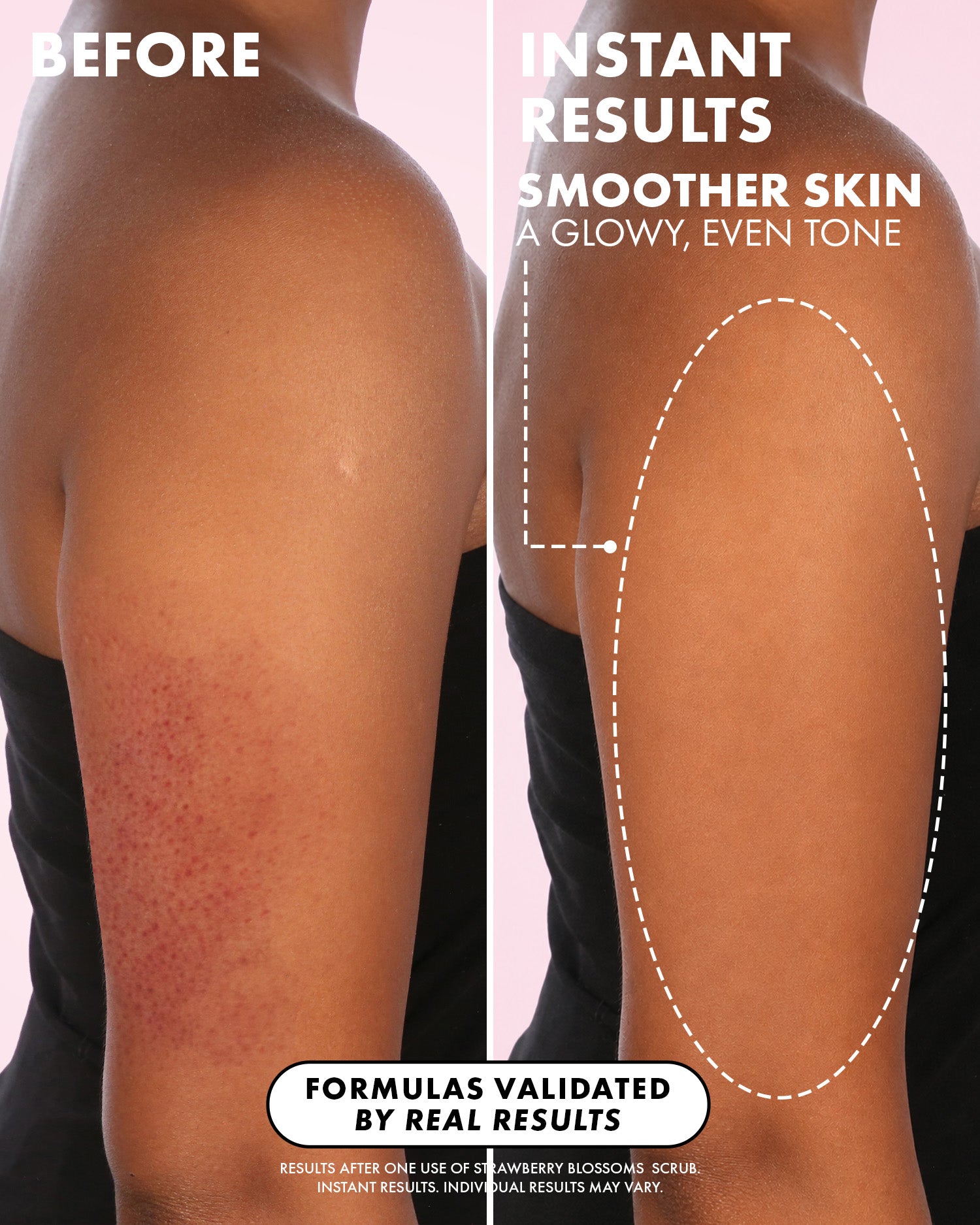 Before-and-after split-screen comparison of a person's upper back and shoulder, showing red bumpy skin on the left and smoother, clearer skin on the right, with promotional text about instant results and smoother skin.