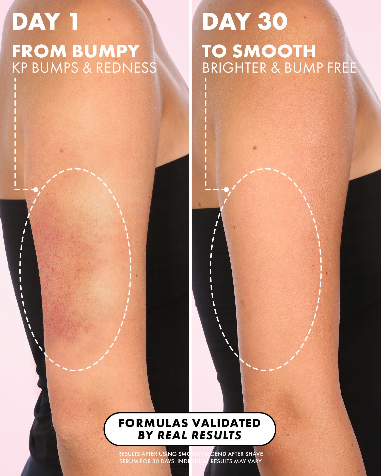 Side-by-side comparison of an arm: left, red and bumpy keratosis pilaris skin labeled Day 1; right, smoother skin at Day 30. Text highlights reduced bumps and redness after using Truly Beauty’s Smooth Legend After Shave Serum.