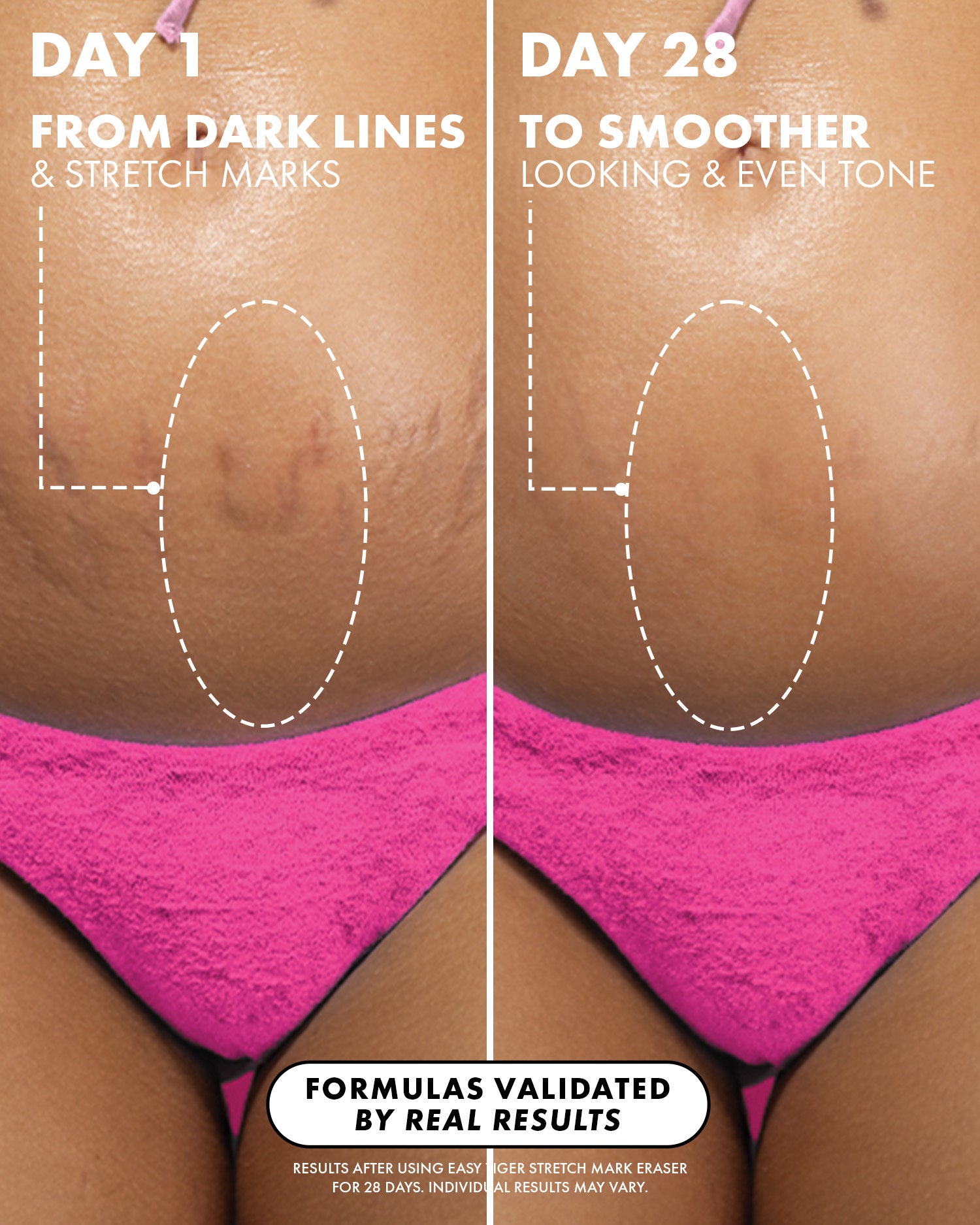 Before and after comparison of dark lines and stretch marks on skin, with text indicating product effects.