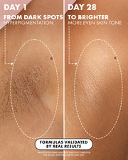 Before and after comparison of dark spots and hyperpigmentation on skin, showing improvement over 28 days.