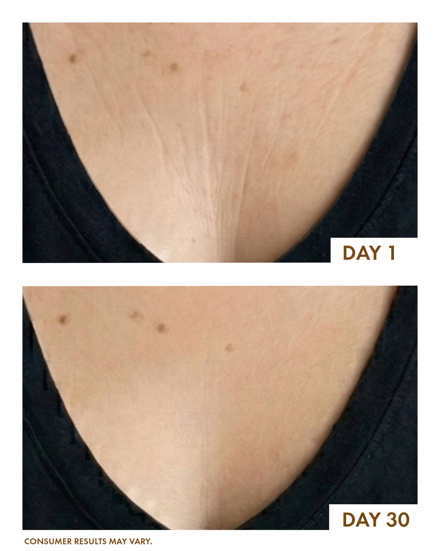 Before and after comparison of skin texture on a person's shoulder over 30 days.