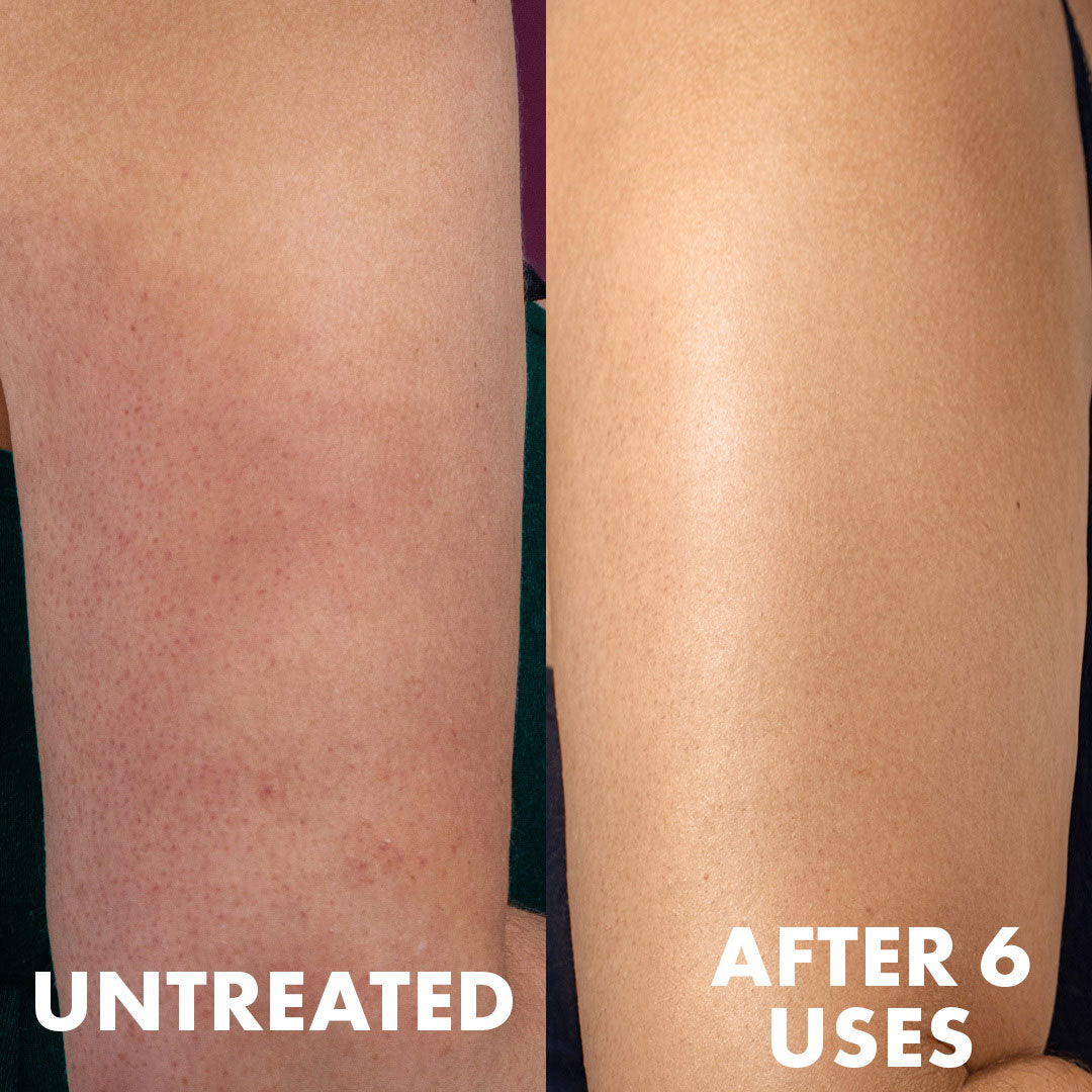 Side-by-side comparison shows untreated skin (red, bumpy, uneven) versus after 6 uses of Truly Beauty Advanced Multi-Acid Complex for Keratosis Pilaris—revealing visibly smoother, clearer, and more even skin texture.