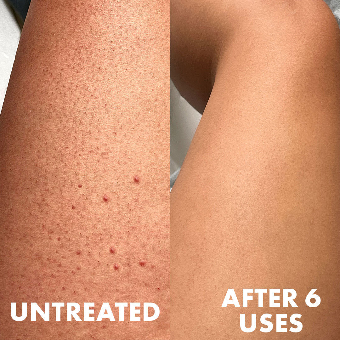 Side-by-side comparison: left shows untreated skin with bumps and redness; right reveals smooth skin after six uses of Truly Beauty Advanced Multi-Acid Complex for Keratosis Pilaris. Labels read UNTREATED and AFTER 6 USES.