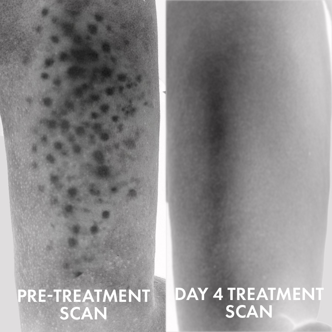 Side-by-side images: left shows many dark spots, labeled PRE-TREATMENT SCAN; right shows smoother skin with fewer spots after 4 days using Truly Beauty Advanced Multi-Acid Complex for Keratosis Pilaris, labeled DAY 4 TREATMENT SCAN.