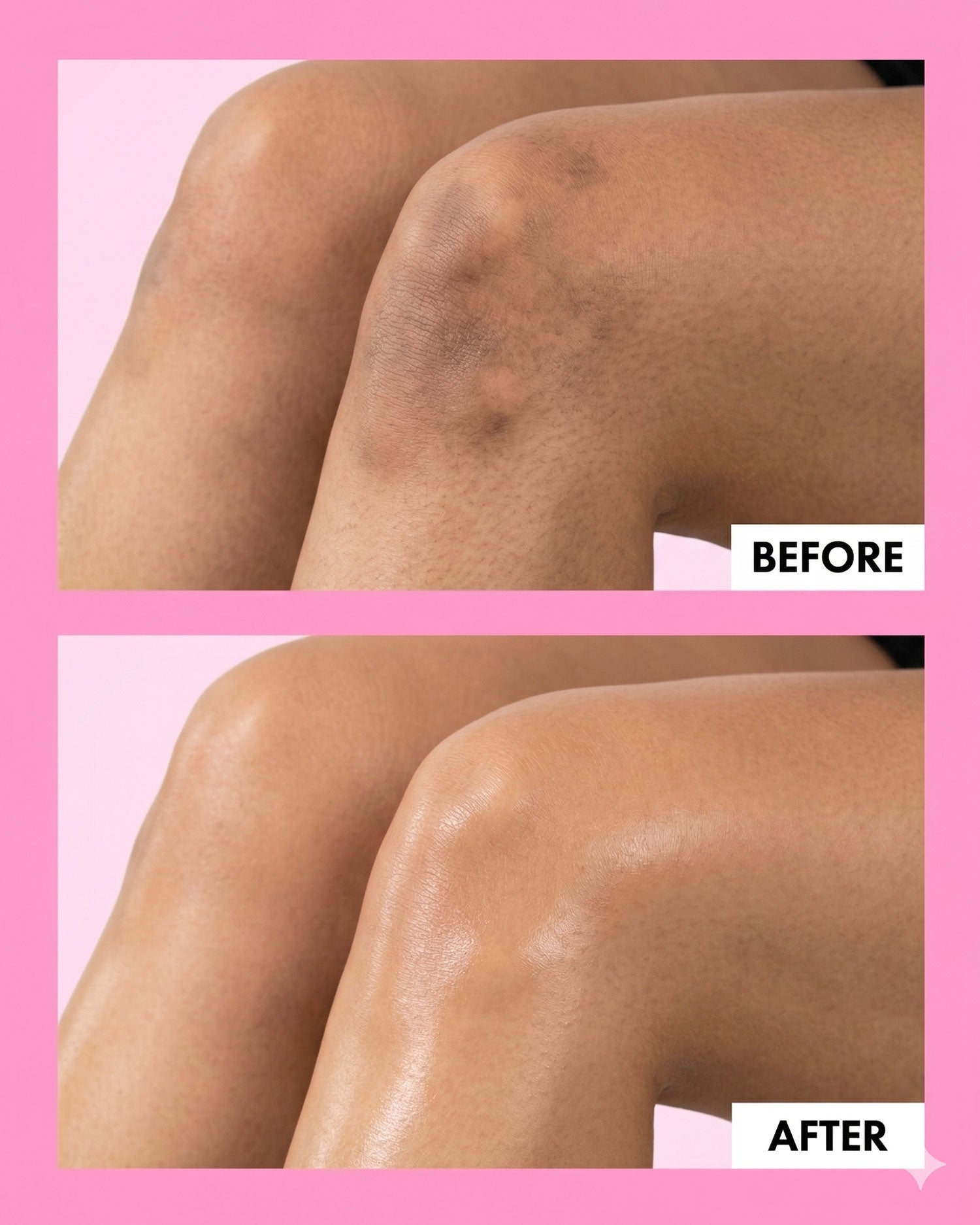 Before and after smooth skin results by Trisha