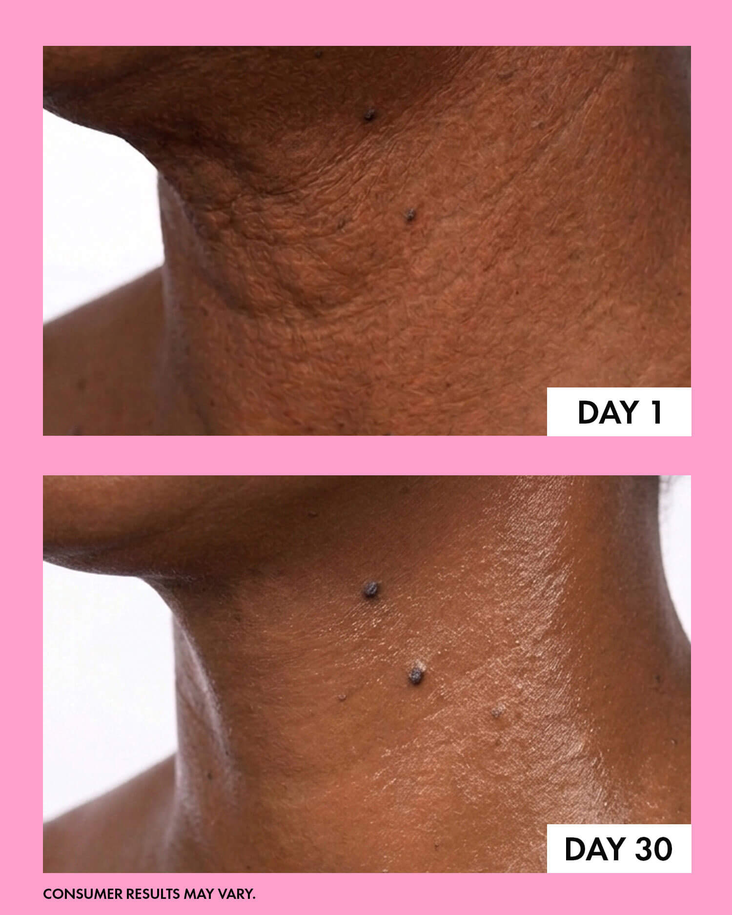 Before and after smooth skin results by Trisha