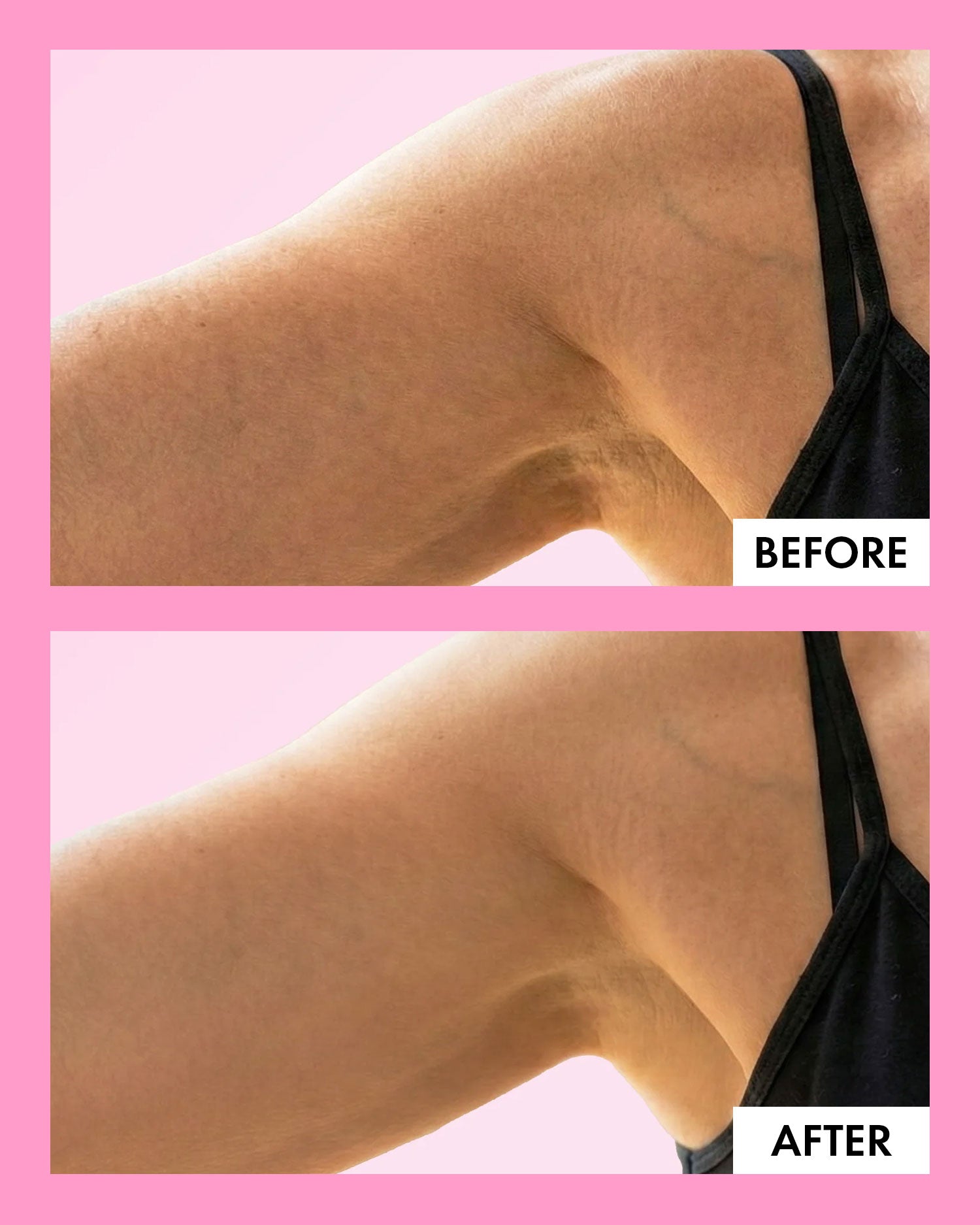 Before and after smooth skin results by Trisha